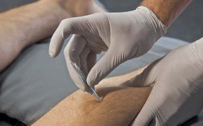 Dry Needling 101