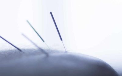 Everything You Need To Know About Dry Needling