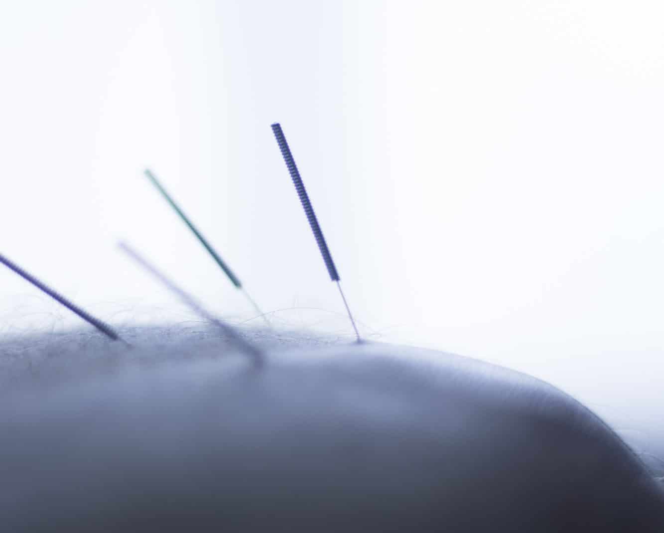 Everything you need to know about dry needling