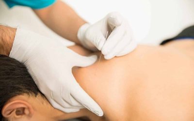 Are Dry Needling and Acupuncture the Same?