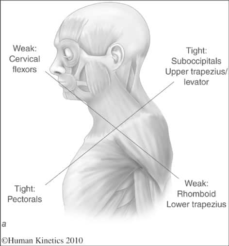 a medical diagram of the neck and shoulders