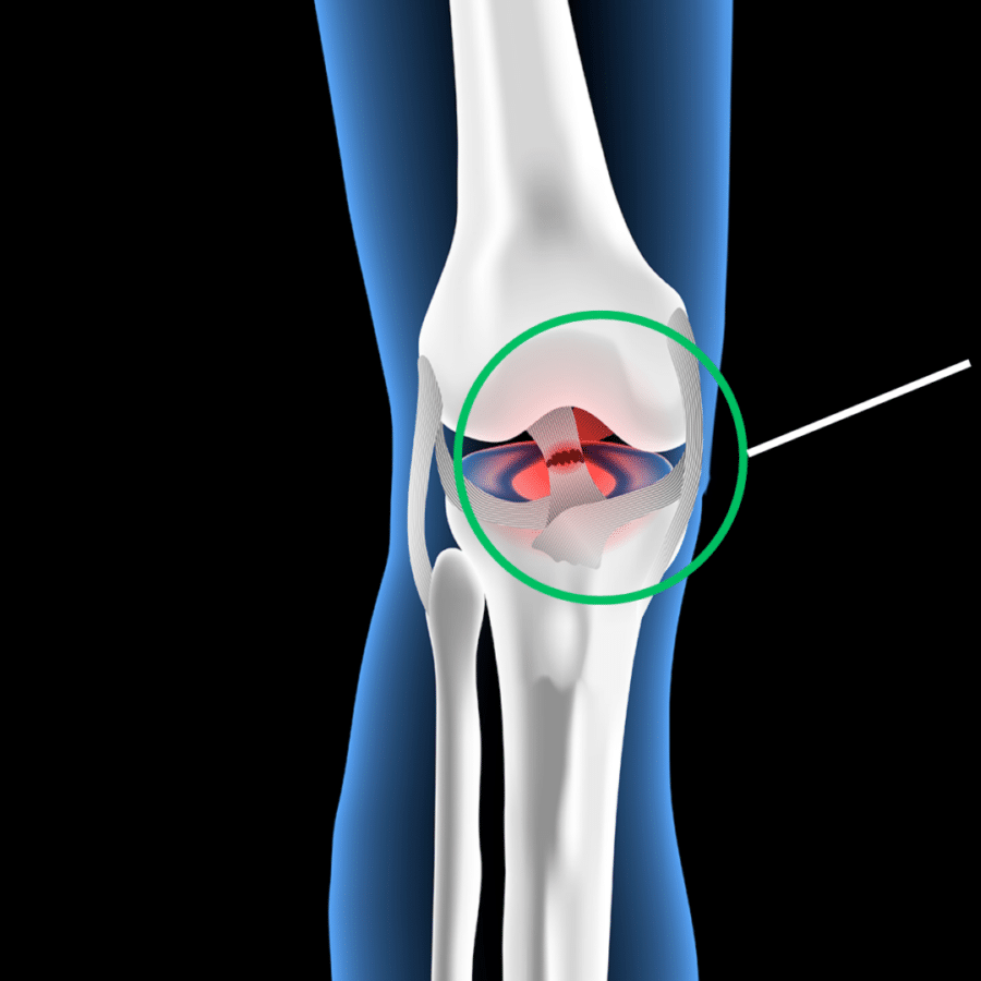 ACL Tear Diagram