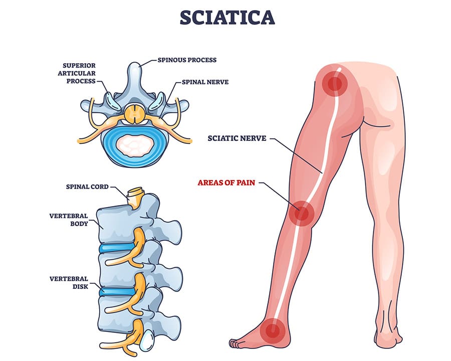 Sciatica areas of pain with anatomical location on leg outline diagram.