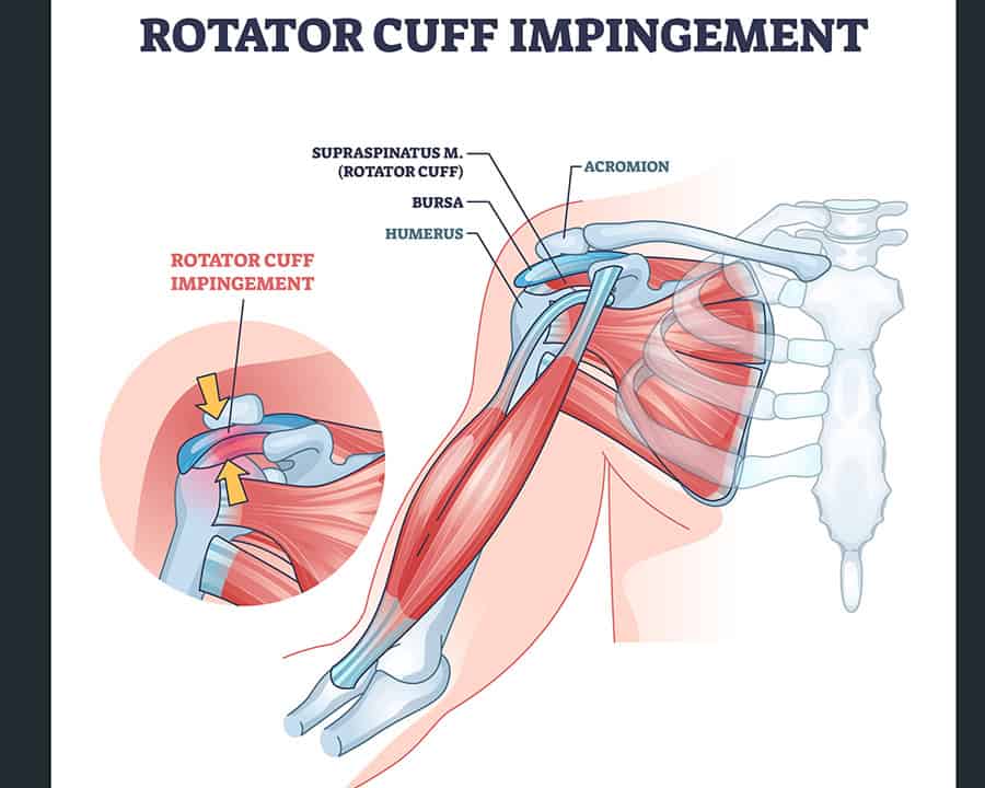 Rotator cuff impingement and anatomical shoulder muscle outline diagram. Labeled educational muscular and skeletal description with injury