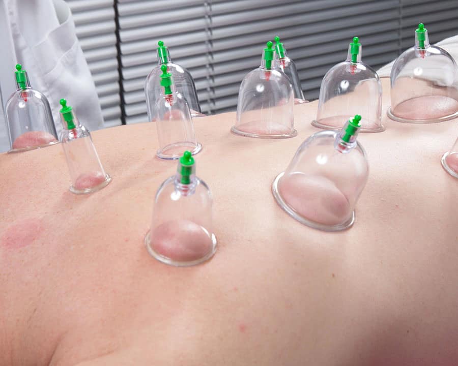 patient receiving cupping therapy on their back by a physical therapist.