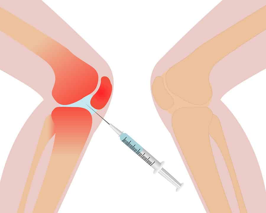 cortisone injection into the knee concept