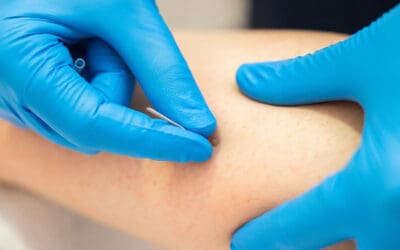 Dry Needling vs. Cupping: Which is Best for Your Chronic Muscle Pain?