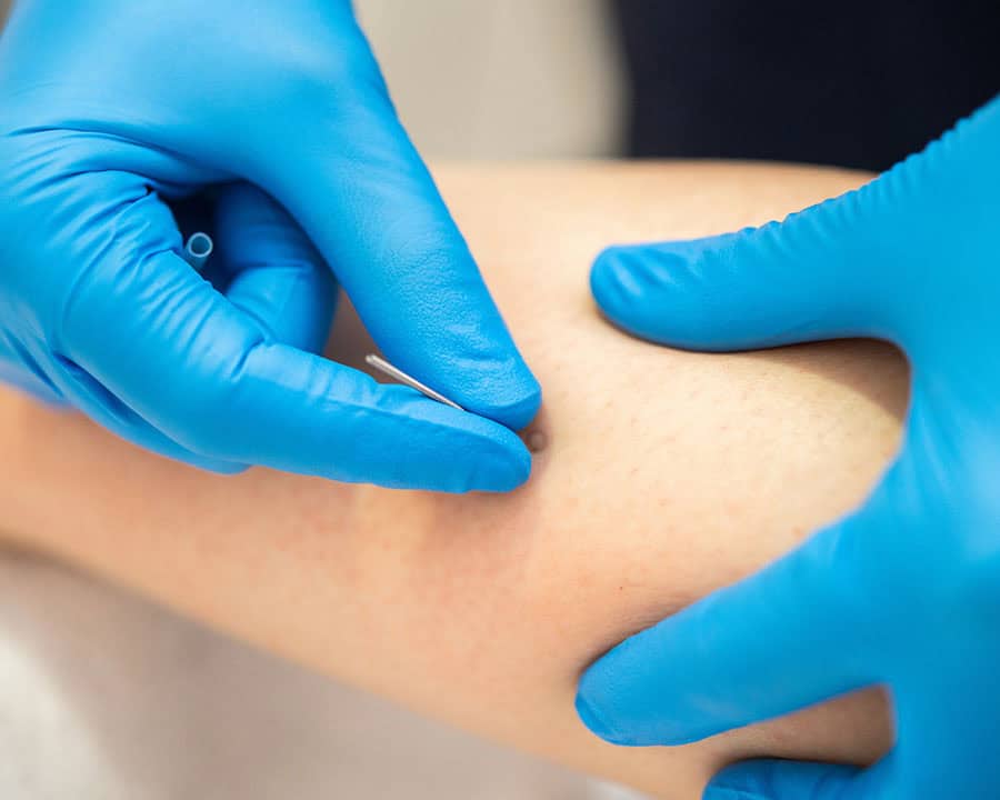 Dry Needling vs. Cupping: Which is Best for Your Chronic Muscle Pain?