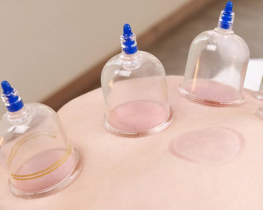 cupping cups applied to the back for pain relief