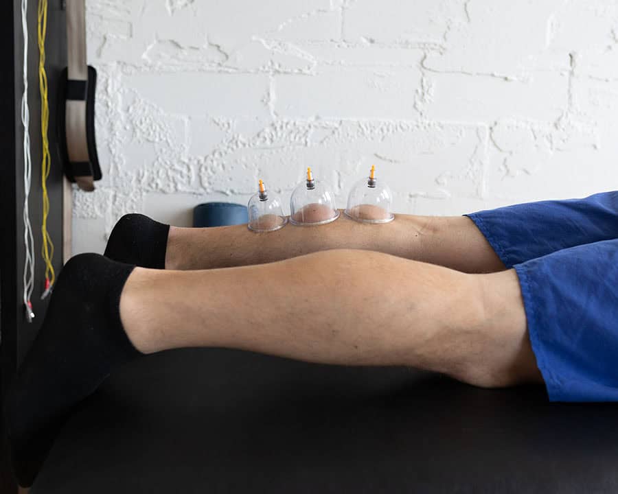 cupping-calf-muscle male patient's calf muscles, with three cupping cups on the back of his leg.