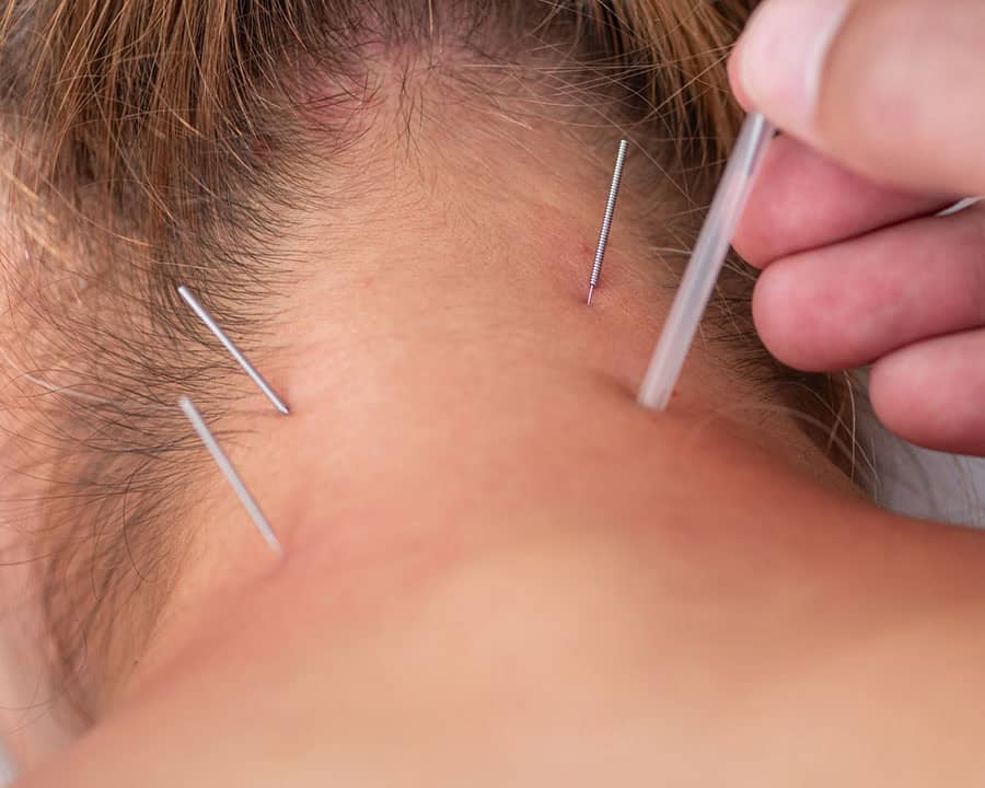 A physical therapist performs dry needling on a patients neck to alleviate muscle tension.
