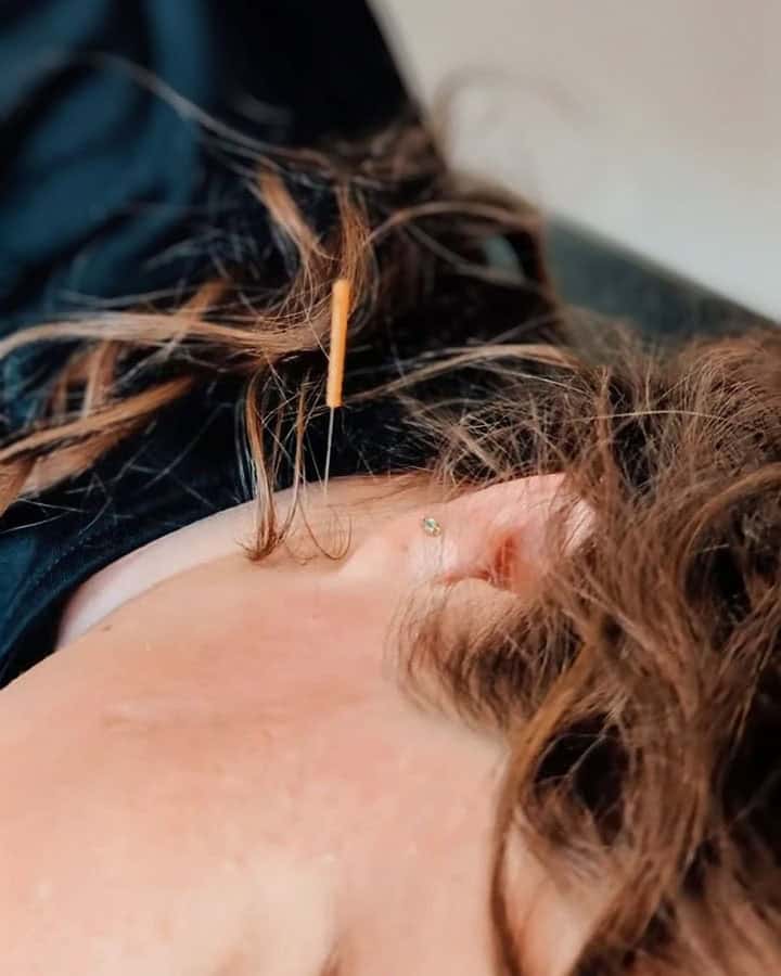 pro-therapy-stemwave-machine close-up of dry-needling needle in the neck